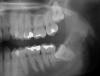 Chirurgická extrakce zubu