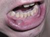 Cysta dutiny ústní