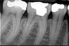 Zubní rentgen (zubní RTG)