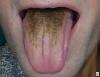 Černý chlupatý jazyk - lingua villosa nigra, black hairy tongue 